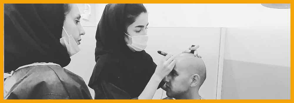 ایران زراعة الشعر