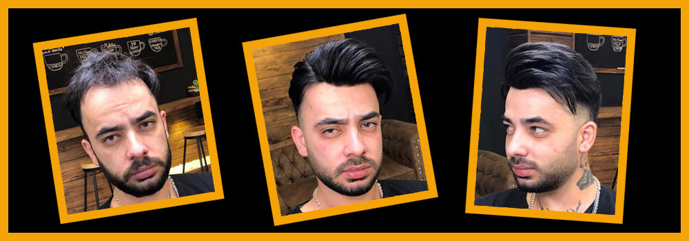 ایران زراعة الشعر