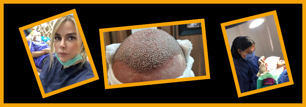 ایران زراعة الشعر